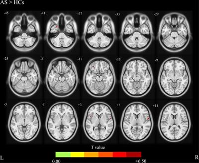 Altered cerebral blood flow patterns in ankylosing spondylitis: A three-dimensional pseudo-continuous arterial spin labeling study